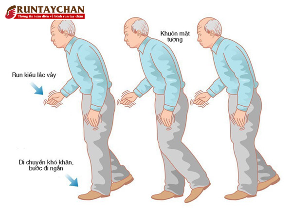 Hội chứng Parkinson do rối loạn ngoại tháp gây ra các triệu chứng run, cứng cơ và chậm vận động